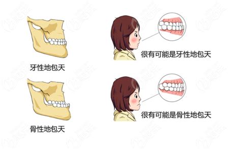 地包|地包天手术（持续更新）